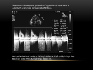 Mean gradient varies according to the length of diastole: it is 8 mmHg during a short
diastole (A) and 6 mmHg during a longer diastole (B).
Determination of mean mitral gradient from Doppler diastolic mitral flow in a
patient with severe mitral stenosis in atrial fibrillation.
 