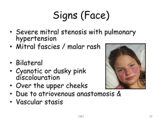 Signs (Face)
• Severe mitral stenosis with pulmonary
hypertension
• Mitral fascies / malar rash
• Bilateral
• Cyanotic or dusky pink
discolouration
• Over the upper cheeks
• Due to atriovenous anastomosis &
• Vascular stasis
JMJ 10
 