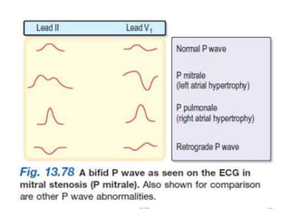 Investigations –ECG
JMJ 21
 