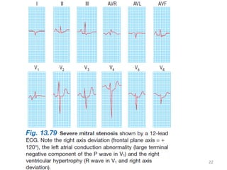 Investigations –ECG
JMJ 22
 