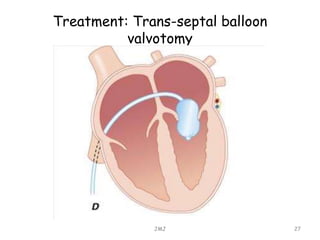 Treatment: Trans-septal balloon
valvotomy
JMJ 27
 