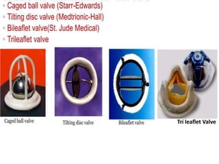 Tri leaflet Valve
 