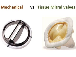Mechanical vs Tissue Mitral valves
 