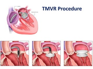 TMVR Procedure
 