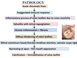 PATHOLOGY
Acute rheumatic fever
Exaggerated immune response
Inflammatory process of valve leaflets due to cross reactivity
Valvulitis with mitral regurgitation
Chronic inflammation + fibrosis
Diffuse thickening of valve leaflets
Mitral commisure fused,Chordae tendinae shortens, valvular cusps rigid
Narrowing at apex – fish mouth appearance
Calcification – Immobilisation of valve leaflet
 