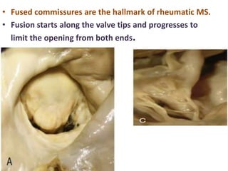 • Fused commissures are the hallmark of rheumatic MS.
• Fusion starts along the valve tips and progresses to
limit the opening from both ends.
 
