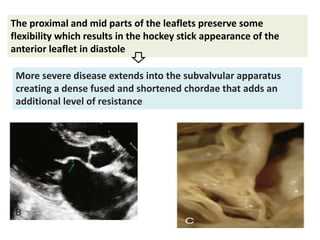 The proximal and mid parts of the leaflets preserve some
flexibility which results in the hockey stick appearance of the
anterior leaflet in diastole
More severe disease extends into the subvalvular apparatus
creating a dense fused and shortened chordae that adds an
additional level of resistance
 
