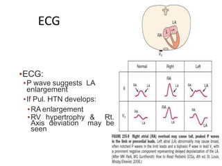 ECG
▪ECG:
▪P wave suggests LA
enlargement
▪If Pul. HTN develops:
▪RA enlargement
▪RV hypertrophy & Rt.
Axis deviation may be
seen
 
