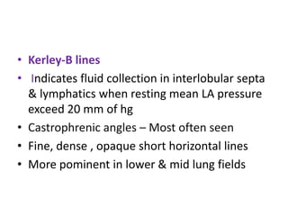 • Kerley-B lines
• Indicates fluid collection in interlobular septa
& lymphatics when resting mean LA pressure
exceed 20 mm of hg
• Castrophrenic angles – Most often seen
• Fine, dense , opaque short horizontal lines
• More pominent in lower & mid lung fields
 