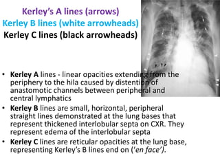 Kerley’s A lines (arrows)
Kerley B lines (white arrowheads)
Kerley C lines (black arrowheads)
• Kerley A lines - linear opacities extending from the
periphery to the hila caused by distention of
anastomotic channels between peripheral and
central lymphatics
• Kerley B lines are small, horizontal, peripheral
straight lines demonstrated at the lung bases that
represent thickened interlobular septa on CXR. They
represent edema of the interlobular septa
• Kerley C lines are reticular opacities at the lung base,
representing Kerley’s B lines end on (‘en face’).
 