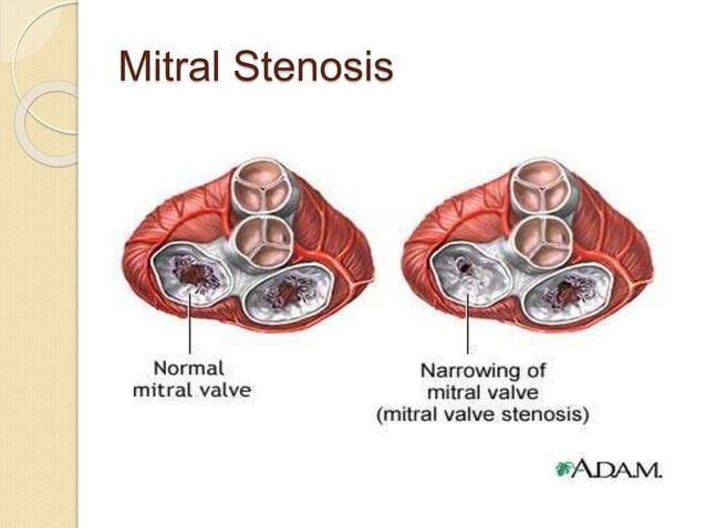 Mitral stenosis and regurgitation sushila | PPT | Heart and ...