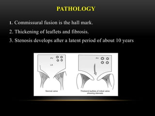 PATHOLOGY
1. Commissural fusion is the hall mark.
2. Thickening of leaflets and fibrosis.
3. Stenosis develops after a latent period of about 10 years
 