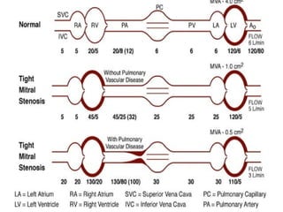 Mitral Stenosis- Pathophysiology, diagnosis and management | PPTX