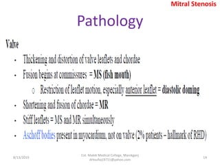 Pathology
8/13/2019
Col. Malek Medical College, Manikganj
drtoufiq19711@yahoo.com
14
Mitral Stenosis
 
