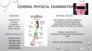 GENERAL PHYSICAL EXAMINATION
OEDEMA
SEVERE MITRAL
STENOSIS
ULTIMATELY
LEADS TO RIGHT
HEART FAILURE.
HEPATOMEGALY
SEEN IN RIGHT
VENTRICULAR
FAILURE AND
PULMONARY
HYPERTENSION.
MITRAL FACIES
LOW CARDIAC OUTPUT IN MITRAL
STENOSIS CAUSES PERIPHERAL
VASOCONSTRICTION PRODUCING
PINKISH PURPLE PATCHES ON CHEEKS.
MITRAL FLUSH DUE TO
VASODILATATION (VASCULAR STASIS) IS
SEEN
SEEN IN FAIR SKINNED INDIVIDUALS
 
