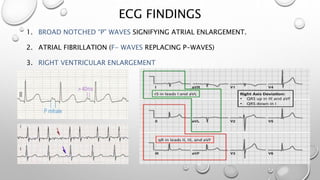 ECG FINDINGS
1. BROAD NOTCHED “P” WAVES SIGNIFYING ATRIAL ENLARGEMENT.
2. ATRIAL FIBRILLATION (F- WAVES REPLACING P-WAVES)
3. RIGHT VENTRICULAR ENLARGEMENT
 