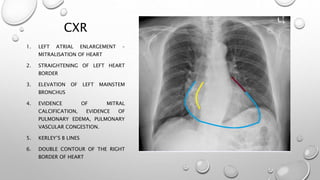 CXR
1. LEFT ATRIAL ENLARGEMENT –
MITRALISATION OF HEART
2. STRAIGHTENING OF LEFT HEART
BORDER
3. ELEVATION OF LEFT MAINSTEM
BRONCHUS
4. EVIDENCE OF MITRAL
CALCIFICATION, EVIDENCE OF
PULMONARY EDEMA, PULMONARY
VASCULAR CONGESTION.
5. KERLEY’S B LINES
6. DOUBLE CONTOUR OF THE RIGHT
BORDER OF HEART
 