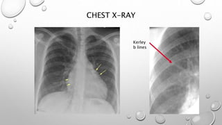 CHEST X-RAY
Kerley
b lines
 