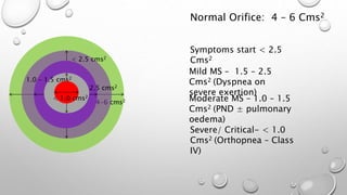 4-6 cms2
< 2.5 cms2
1.5- 2.5 cms2
1.0 – 1.5 cms2
< 1.0 cms2
Mild MS – 1.5 – 2.5
Cms2 (Dyspnea on
severe exertion)
Moderate MS – 1.0 – 1.5
Cms2 (PND ± pulmonary
oedema)
Severe/ Critical- < 1.0
Cms2 (Orthopnea – Class
IV)
Symptoms start < 2.5
Cms2
Normal Orifice: 4 – 6 Cms2
 