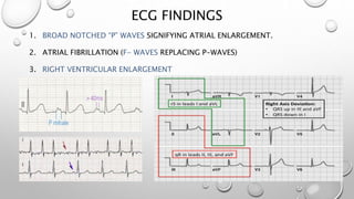 ECG FINDINGS
1. BROAD NOTCHED “P” WAVES SIGNIFYING ATRIAL ENLARGEMENT.
2. ATRIAL FIBRILLATION (F- WAVES REPLACING P-WAVES)...