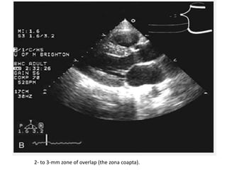 2- to 3-mm zone of overlap (the zona coapta).
 
