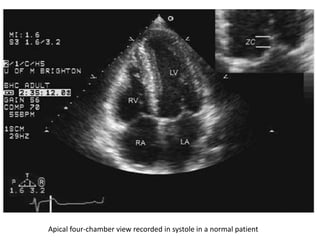 Apical four-chamber view recorded in systole in a normal patient
 