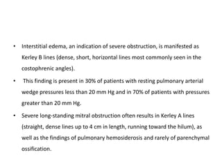 • Interstitial edema, an indication of severe obstruction, is manifested as
Kerley B lines (dense, short, horizontal lines most commonly seen in the
costophrenic angles).
• This finding is present in 30% of patients with resting pulmonary arterial
wedge pressures less than 20 mm Hg and in 70% of patients with pressures
greater than 20 mm Hg.
• Severe long-standing mitral obstruction often results in Kerley A lines
(straight, dense lines up to 4 cm in length, running toward the hilum), as
well as the findings of pulmonary hemosiderosis and rarely of parenchymal
ossification.
 
