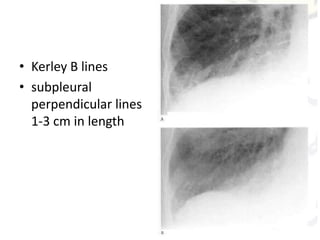 • Kerley B lines
• subpleural
perpendicular lines
1-3 cm in length
 