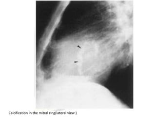 Calcification in the mitral ring(lateral view )
 