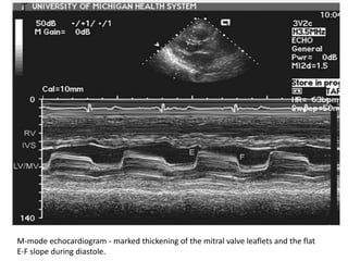 M-mode echocardiogram - marked thickening of the mitral valve leaflets and the flat
E-F slope during diastole.
 