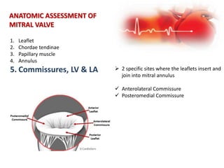 ANATOMIC ASSESSMENT OF
MITRAL VALVE
1. Leaflet
2. Chordae tendinae
3. Papillary muscle
4. Annulus
5. Commissures, LV & LA  2 specific sites where the leaflets insert and
join into mitral annulus
 Anterolateral Commissure
 Posteromedial Commissure
 