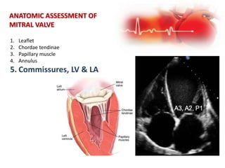 ANATOMIC ASSESSMENT OF
MITRAL VALVE
1. Leaflet
2. Chordae tendinae
3. Papillary muscle
4. Annulus
5. Commissures, LV & LA
 