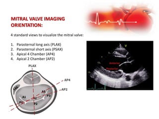 MITRAL VALVE IMAGING
ORIENTATION:
4 standard views to visualize the mitral valve:
1. Parasternal long axis (PLAX)
2. Parasternal short axis (PSAX)
3. Apical 4 Chamber (AP4)
4. Apical 2 Chamber (AP2)
 