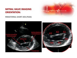 PARASTERNAL SHORT AXIS (PSAX)
MITRAL VALVE IMAGING
ORIENTATION:
 