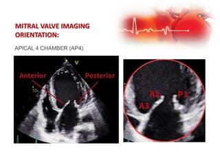 MITRAL VALVE IMAGING
ORIENTATION:
APICAL 4 CHAMBER (AP4)
 