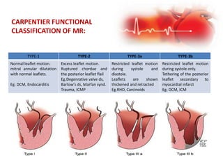 CARPENTIER FUNCTIONAL
CLASSIFICATION OF MR:
TYPE-1 TYPE-2 TYPE-3a TYPE-3b
Normal leaflet motion.
mitral annular dilatation
with normal leaflets.
Eg. DCM, Endocarditis
Excess leaflet motion.
Ruptured chordae and
the posterior leaflet flail
Eg.Degenrative valve ds,
Barlow's ds, Marfan synd.
Trauma, ICMP
Restricted leaflet motion
during systole and
diastole.
Leaflets are shown
thickened and retracted
Eg.RHD, Carcinoids
Restricted leaflet motion
during systole only.
Tethering of the posterior
leaflet secondary to
myocardial infarct
Eg. DCM, ICM
 
