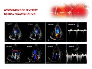 ASSESSMENT OF SEVERITY
MITRAL REGURGITATION
 