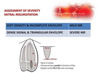 SOFT DENSITY & INCOMPLETE ENVELOPE MILD MR
DENSE SIGNAL & TRIANGULAR ENVELOPE SEVERE MR
ASSESSMENT OF SEVERITY
MITRAL REGURGITATION
 