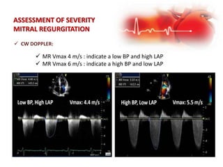  MR Vmax 4 m/s : indicate a low BP and high LAP
 MR Vmax 6 m/s : indicate a high BP and low LAP
 CW DOPPLER:
ASSESSMENT OF SEVERITY
MITRAL REGURGITATION
 