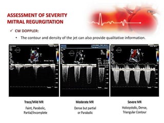  CW DOPPLER:
• The contour and density of the jet can also provide qualitative information.
ASSESSMENT OF SEVERITY
MITRAL REGURGITATION
 