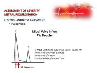 2).SEMIQUANTITATIVE ASSESSMENT:
ASSESSMENT OF SEVERITY
MITRAL REGURGITATION
 PW DOPPLER:
 
