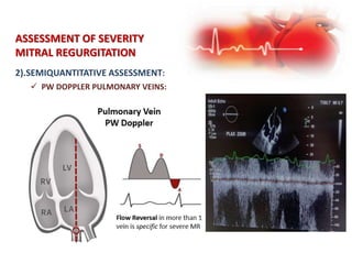 2).SEMIQUANTITATIVE ASSESSMENT:
ASSESSMENT OF SEVERITY
MITRAL REGURGITATION
 PW DOPPLER PULMONARY VEINS:
 