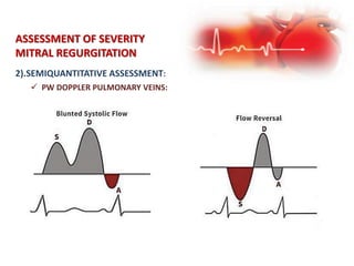 2).SEMIQUANTITATIVE ASSESSMENT:
ASSESSMENT OF SEVERITY
MITRAL REGURGITATION
 PW DOPPLER PULMONARY VEINS:
 