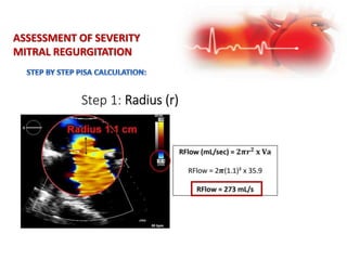 ASSESSMENT OF SEVERITY
MITRAL REGURGITATION
 