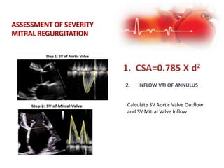 ASSESSMENT OF SEVERITY
MITRAL REGURGITATION
Calculate SV Aortic Valve Outflow
and SV Mitral Valve Inflow
 