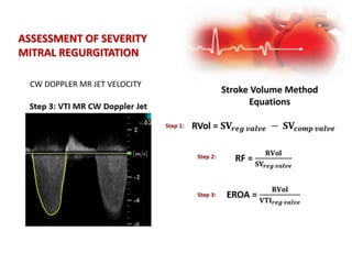 CW DOPPLER MR JET VELOCITY
ASSESSMENT OF SEVERITY
MITRAL REGURGITATION
 