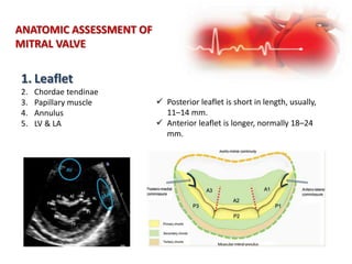 ANATOMIC ASSESSMENT OF
MITRAL VALVE
1. Leaflet
2. Chordae tendinae
3. Papillary muscle
4. Annulus
5. LV & LA
 Posterior leaflet is short in length, usually,
11–14 mm.
 Anterior leaflet is longer, normally 18–24
mm.
 