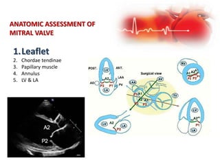 ANATOMIC ASSESSMENT OF
MITRAL VALVE
1.Leaflet
2. Chordae tendinae
3. Papillary muscle
4. Annulus
5. LV & LA
 