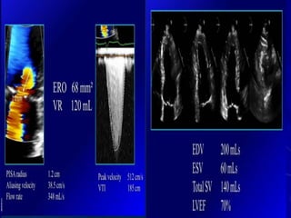 Mitral valve current challenges