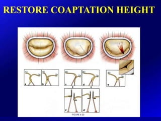Mitral valve current challenges